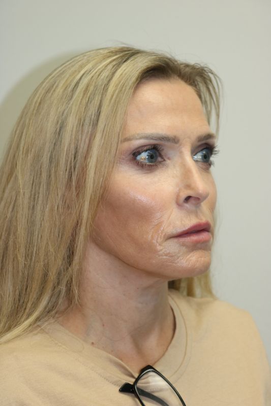 Facelift Before & After