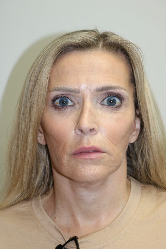 Facelift Before & After