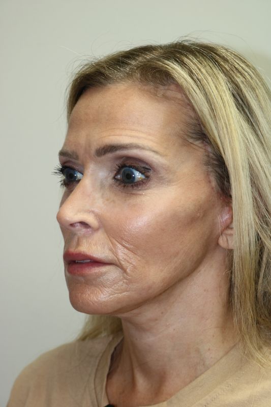 Facelift Before & After