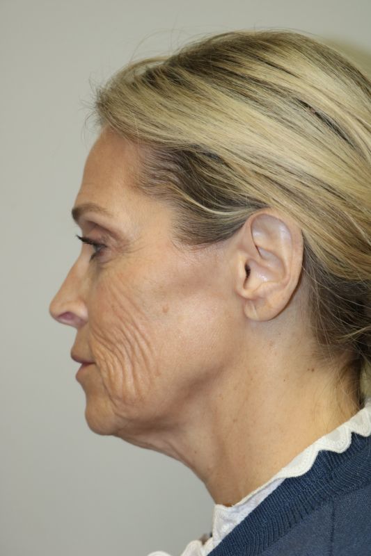 Facelift Before & After