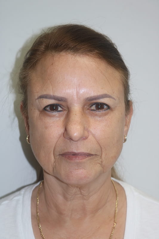 Facelift Before & After Image