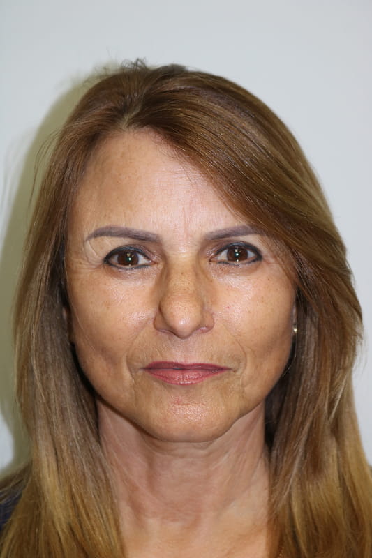 Facelift Before & After Image