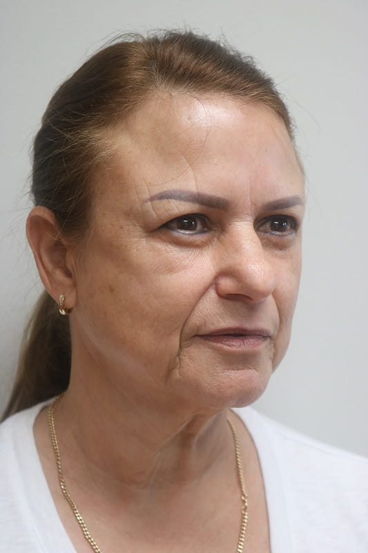 Facelift Before & After