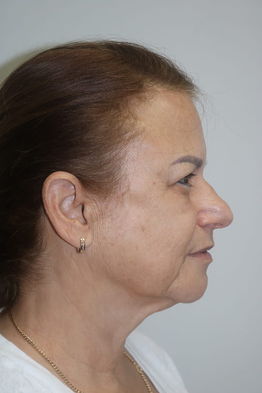 Facelift Before & After