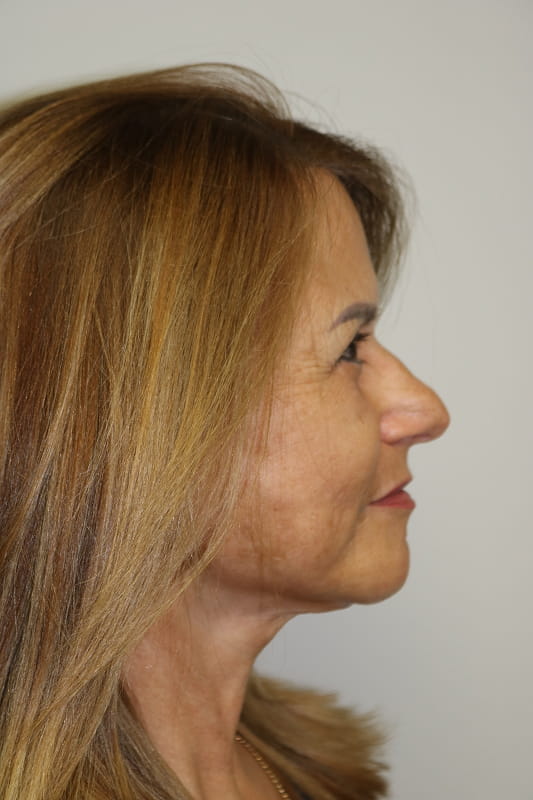 Facelift Before & After