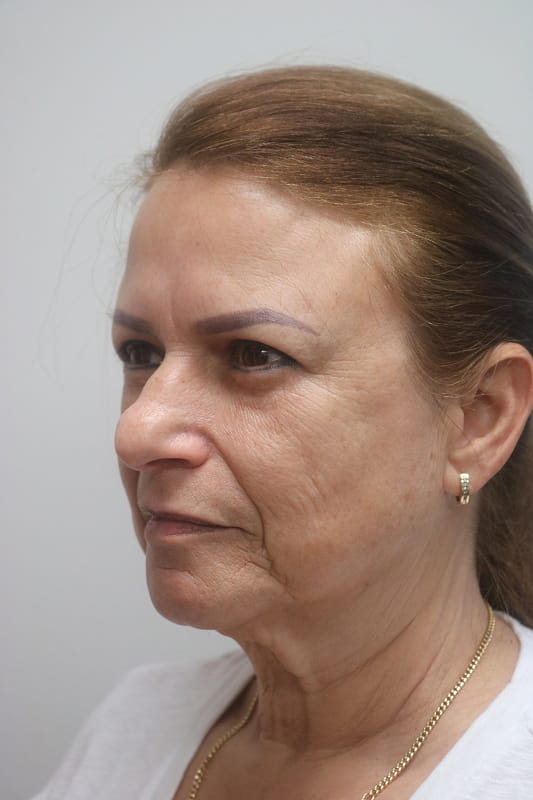 Facelift Before & After