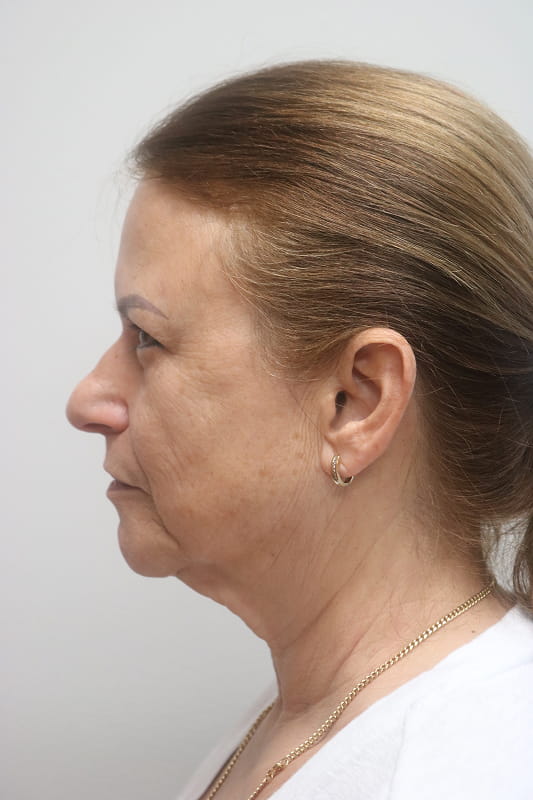 Facelift Before & After