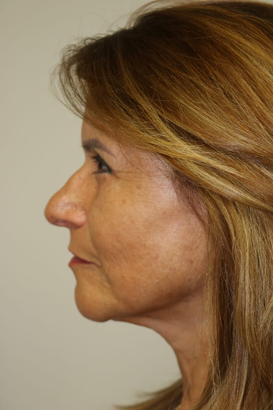 Facelift Before & After