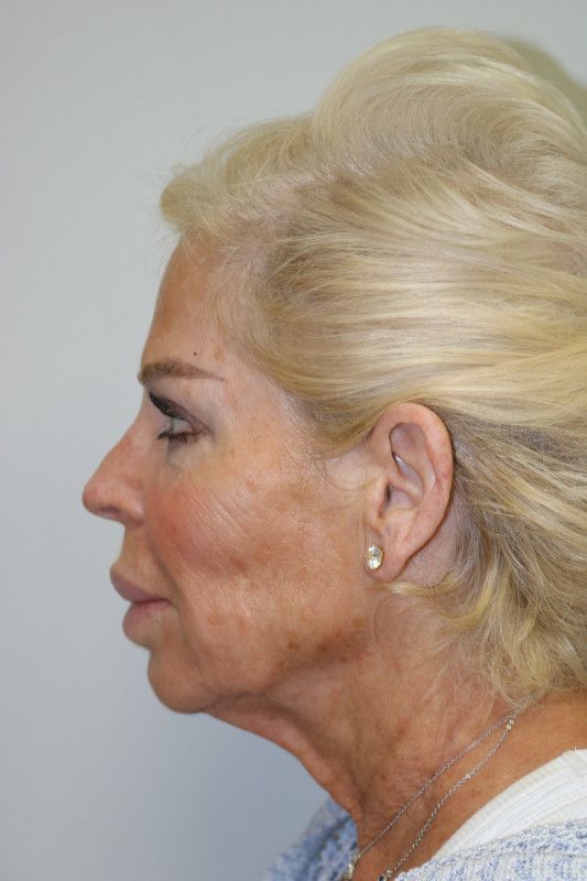 Facelift Before & After