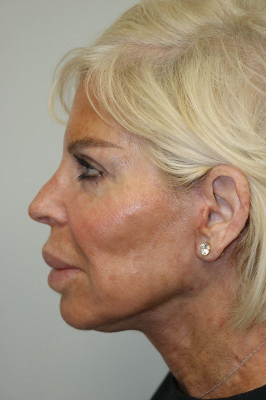 Facelift Before & After