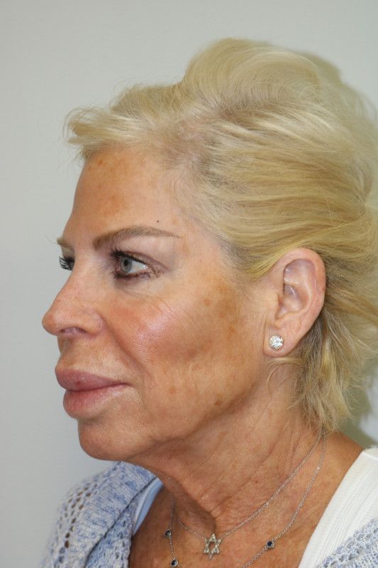 Facelift Before & After