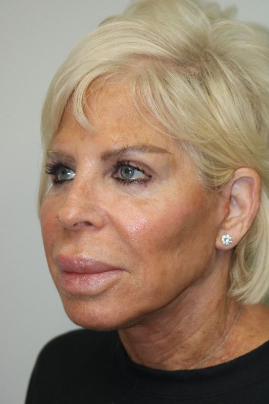 Facelift Before & After