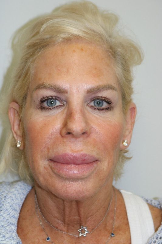 Facelift Before & After