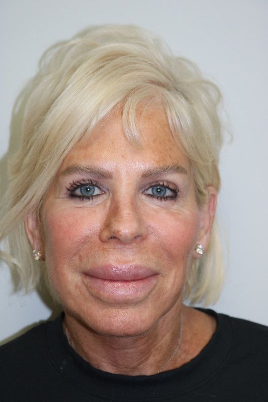Facelift Before & After