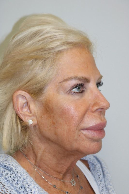 Facelift Before & After