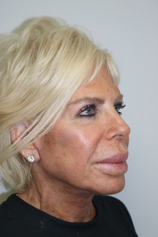 Facelift Before & After