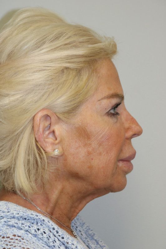 Facelift Before & After