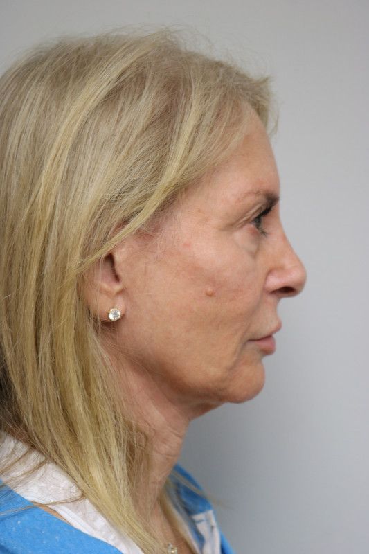 Facelift Before & After