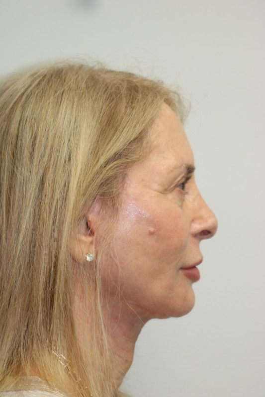 Facelift Before & After