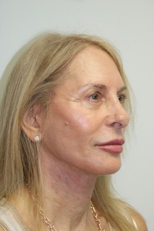 Facelift Before & After