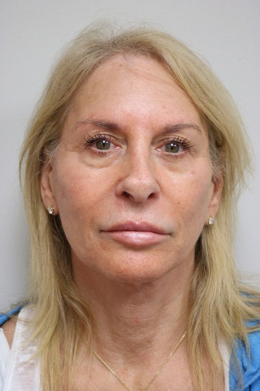 Facelift Before & After
