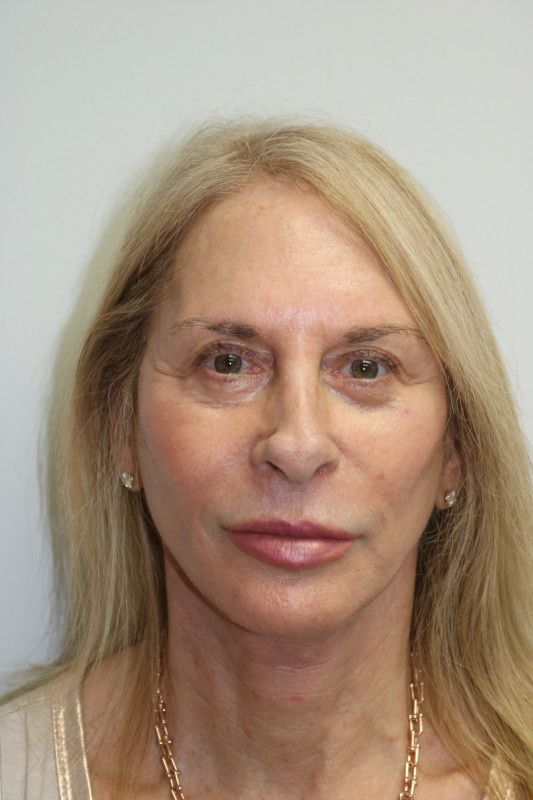 Facelift Before & After