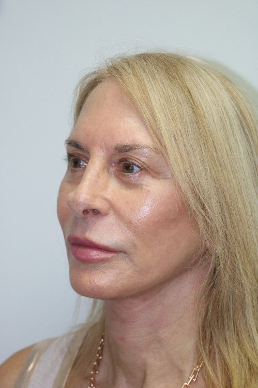 Facelift Before & After