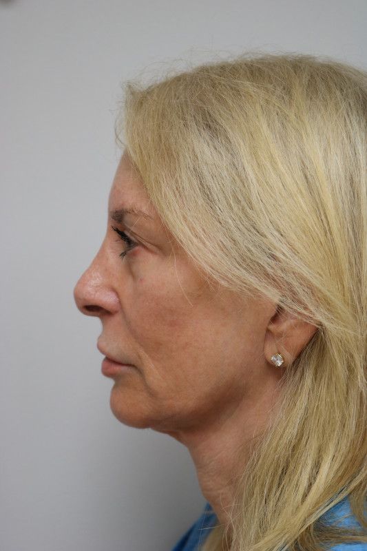 Facelift Before & After