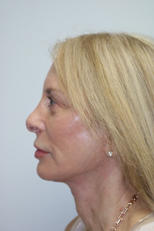 Facelift Before & After