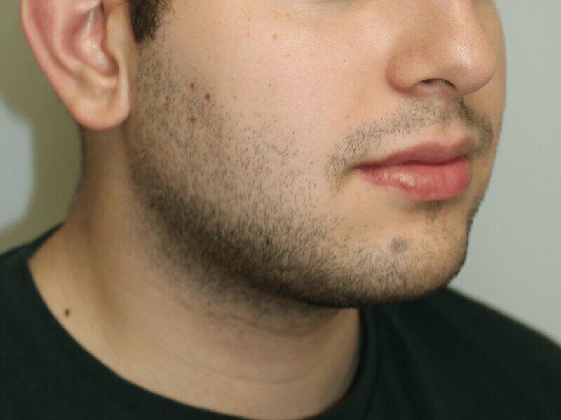 FaceTite Before & After