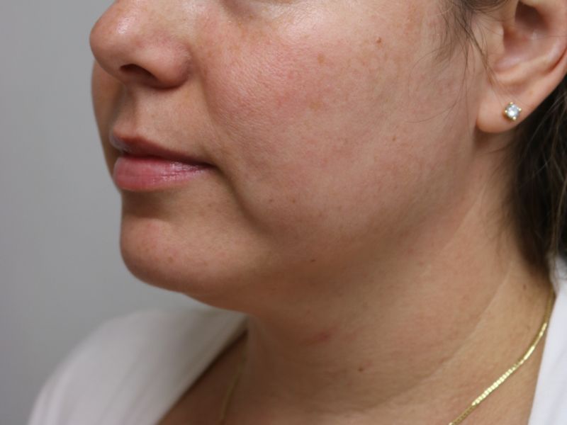 FaceTite Before & After