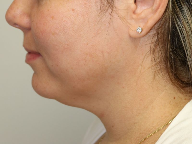 FaceTite Before & After