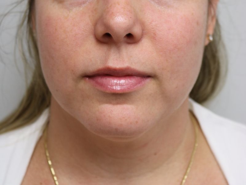 FaceTite Before & After