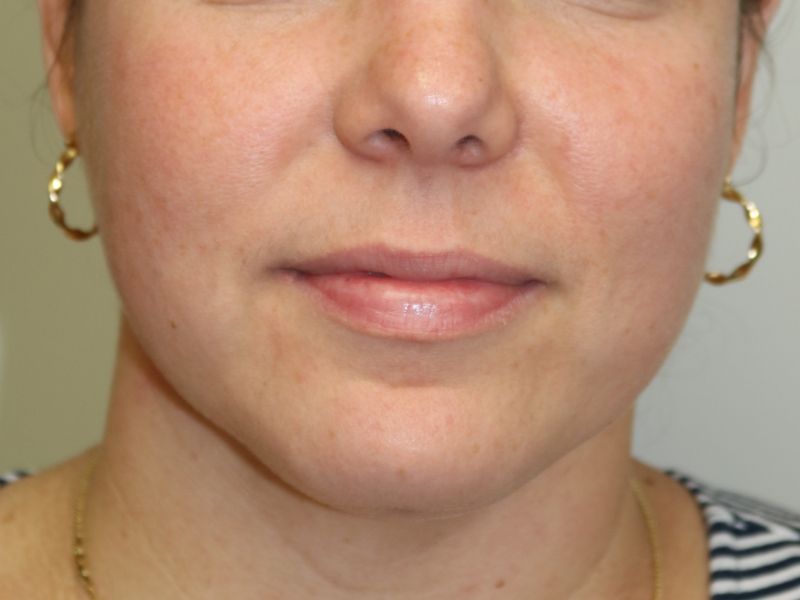 FaceTite Before & After
