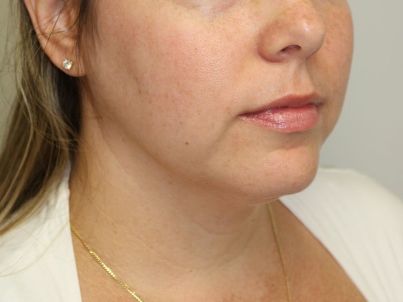FaceTite Before & After