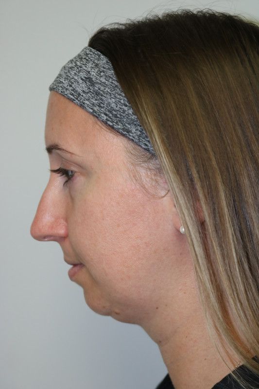 FaceTite Before & After