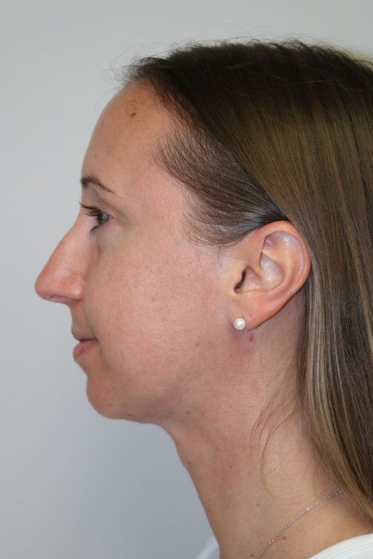 FaceTite Before & After