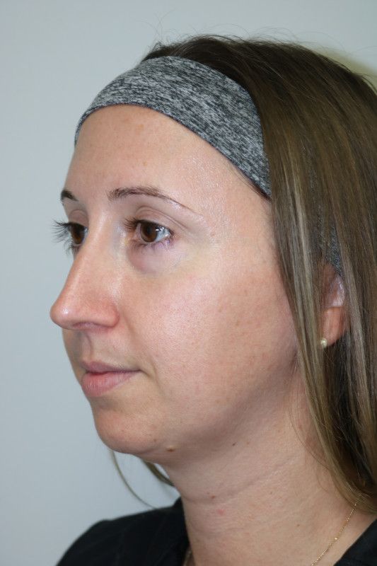 FaceTite Before & After