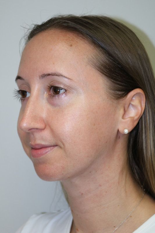 FaceTite Before & After