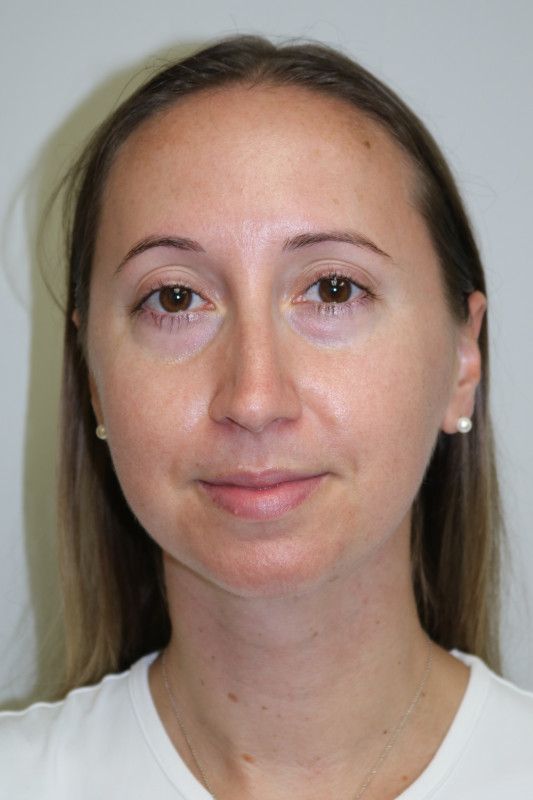 FaceTite Before & After