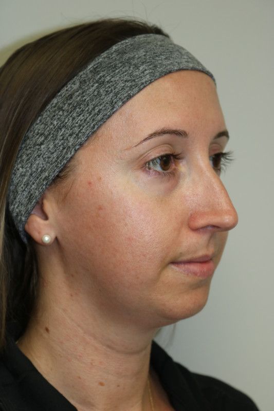 FaceTite Before & After