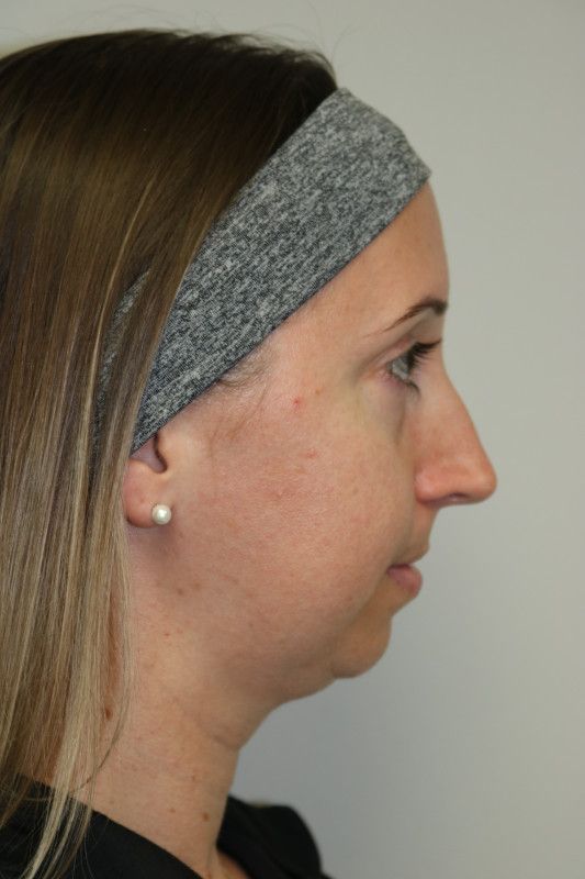 FaceTite Before & After
