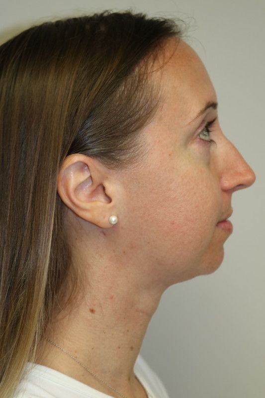 FaceTite Before & After