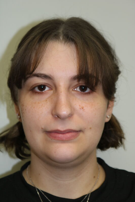 FaceTite Before & After