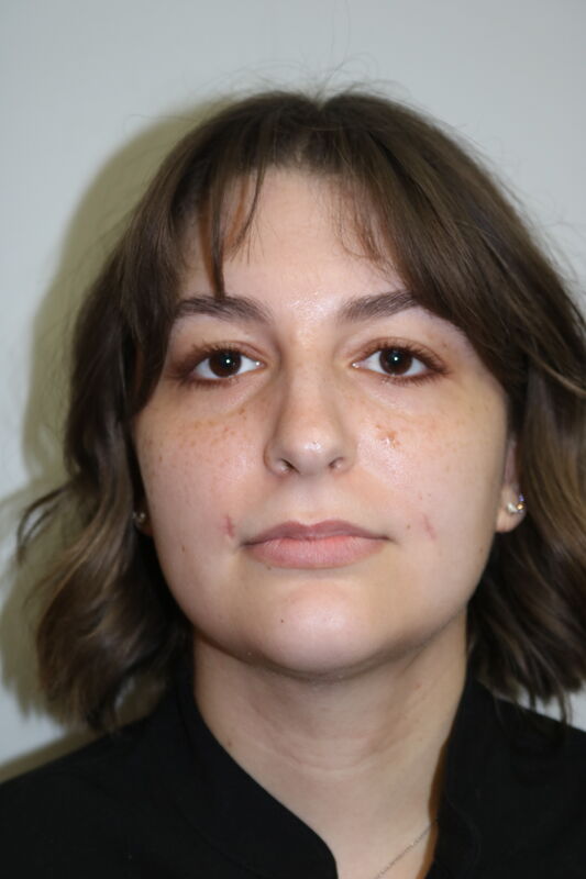FaceTite Before & After