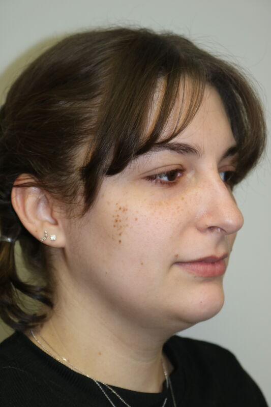 FaceTite Before & After