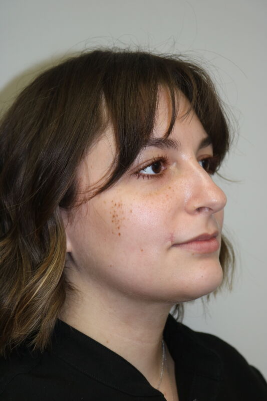 FaceTite Before & After