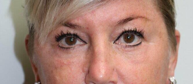 Lower Blepharoplasty Before & After Image