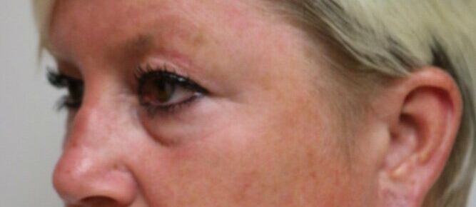 Lower Blepharoplasty Before & After Image