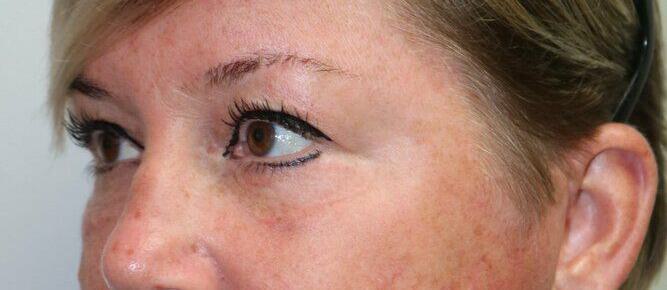 Lower Blepharoplasty Before & After Image